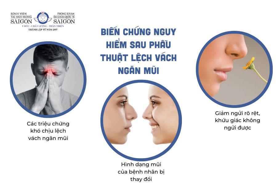 Những điều cần biết về mổ lệch vách ngăn mũi và cách điều trị