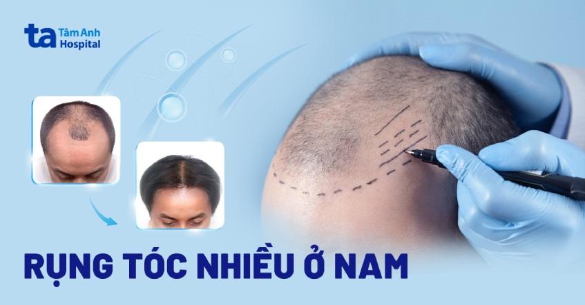 rụng tóc nhiều ở nam