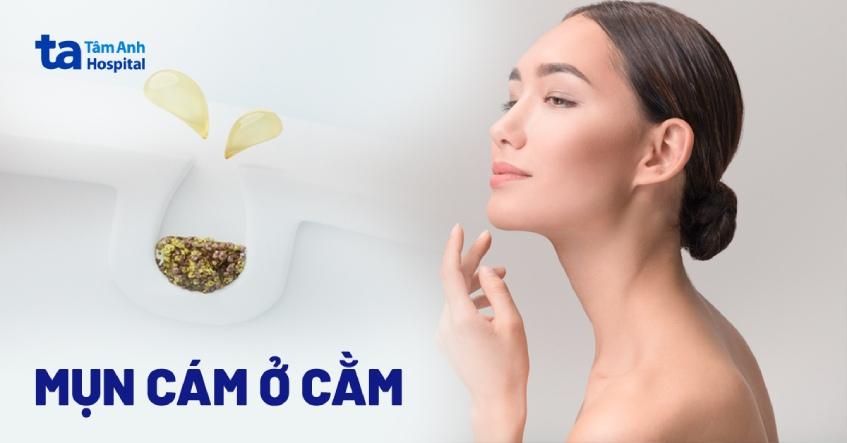 mụn cám ở cằm