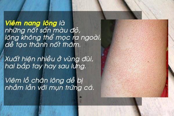 cách trị viêm lỗ chân lông