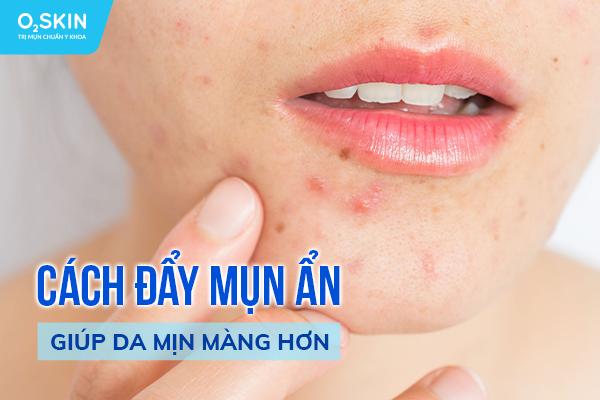 5 cách đẩy mụn ẩn giúp da mịn màng hơn