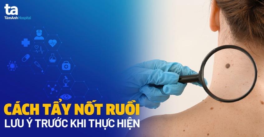 3 cách tẩy nốt ruồi tại cơ sở y tế và nhà: Lưu ý trước khi thực hiện