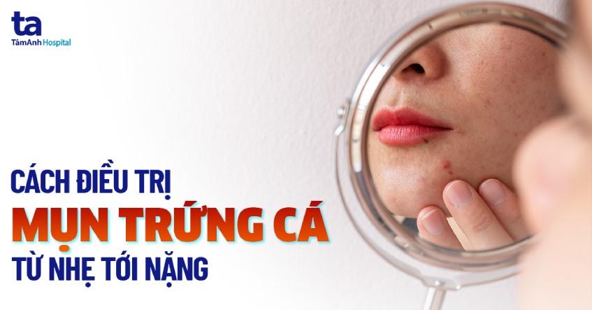 cách điều trị mụn trứng cá