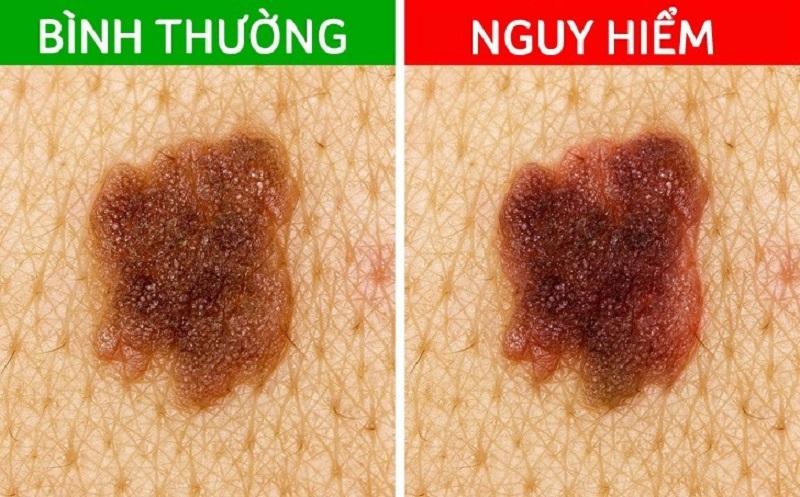 Tự tẩy nốt ruồi tại nhà nếu không xác định được nốt ruồi là lành hay ác tính sẽ vô cùng nguy hiểm