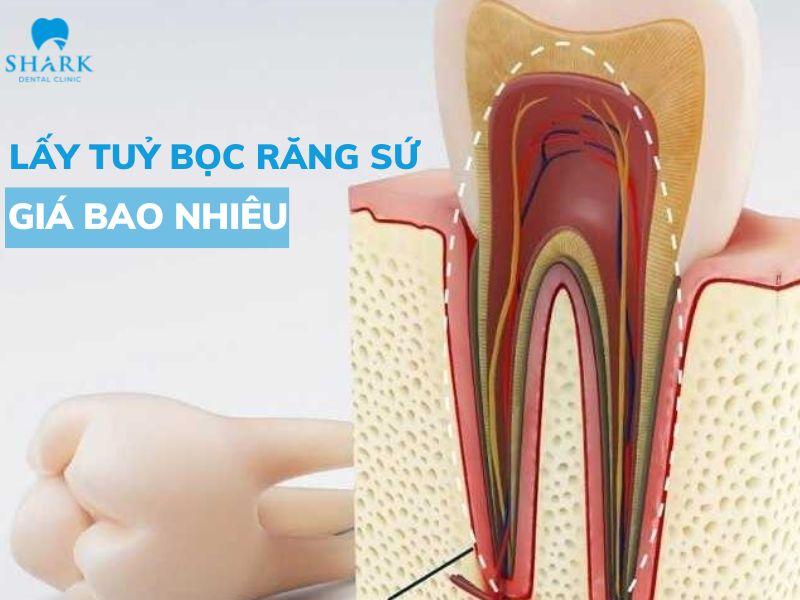 Lấy tủy bọc răng sứ giúp tăng tính thẩm mỹ và đảm bảo chức năng ăn nhai tốt