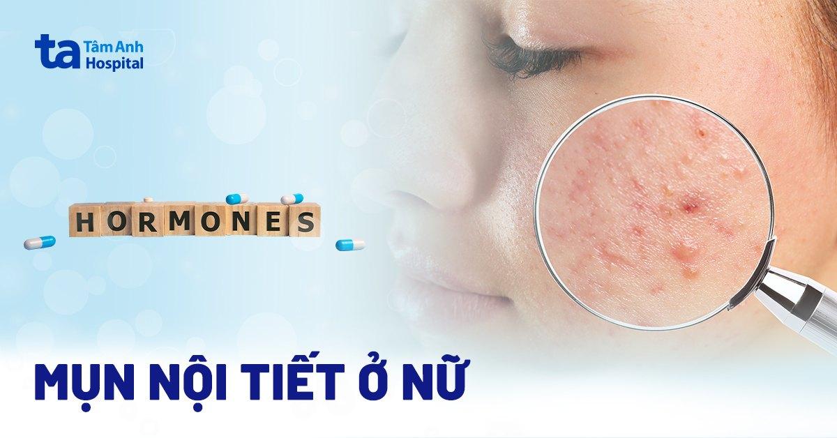 Mụn nội tiết ở nữ giới