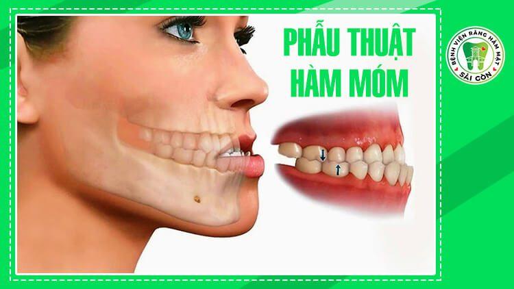 phẫu thuật hàm móm