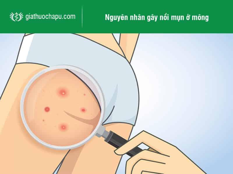 Nguyên nhân gây nổi mụn ở mông