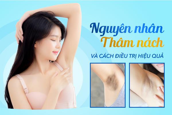 Việc cạo lông nách hoặc dùng lăn khử mùi là những nguyên nhân chính khiến nách dễ bị thâm sạm