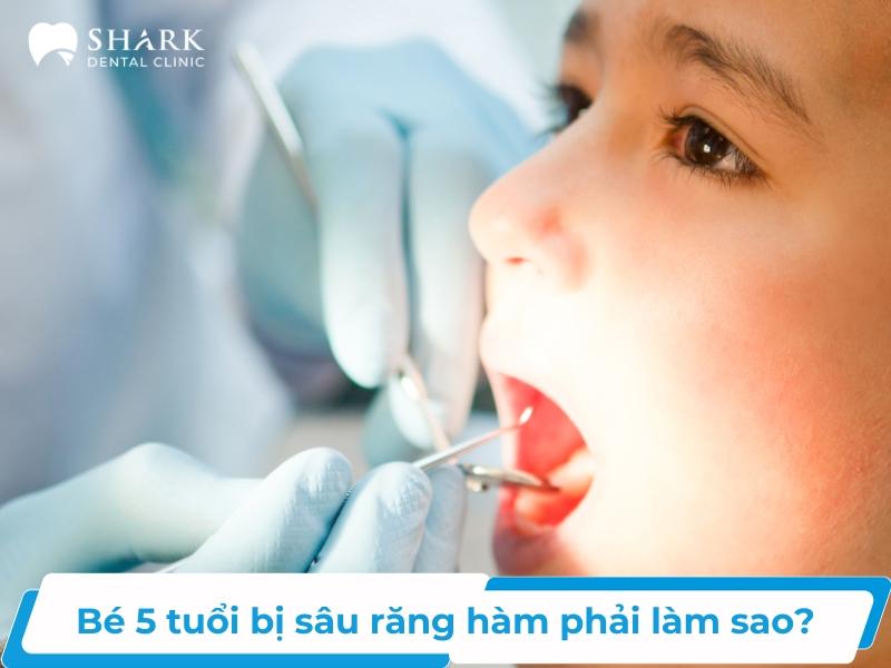 Tình trạng sâu răng giai đoạn 2 sẽ khiến cho bé bị đau răng dai dẳng, khiến bé biếng ăn vì bị ảnh hưởng khả năng ăn nhai