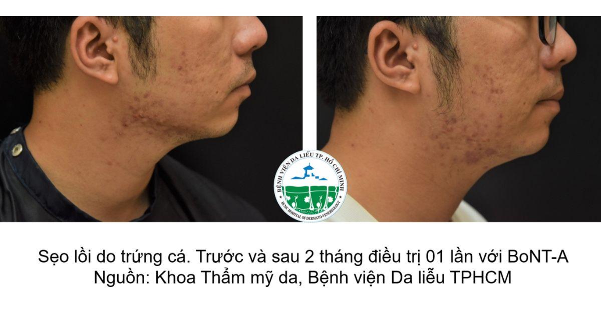 Trường hợp điều trị sẹo lồi trứng cá tại bệnh viện Da liễu TP.HCM