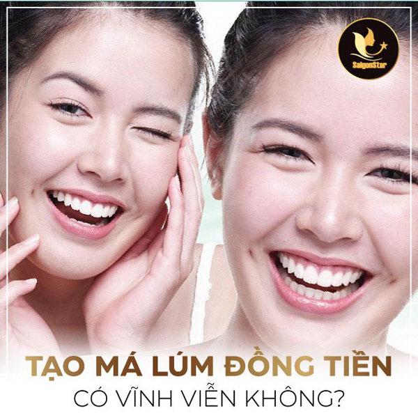 Kỹ thuật tạo má lúm đồng tiền